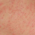 How to distinguish nervous itching from other skin diseases