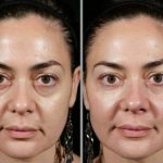 how to remove swelling from the face