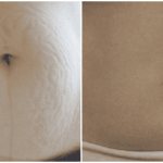 How to remove stretch marks on the stomach after pregnancy