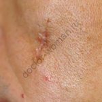 Как убрать с кожи послеоперационные шрамы и посттравматические рубцы с помощью хирургических и косметологических процедур