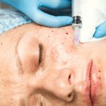 How to remove bruises after mesotherapy