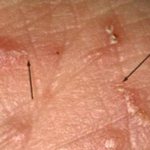 What does scabies look like in humans (photo)