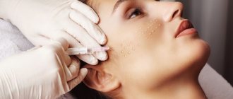 What treatments will help with acne?