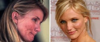 Cameron Diaz acne