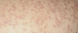 Keratosis, Follicular keratosis