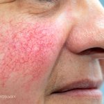 Clinical guidelines for the treatment of rosacea