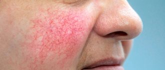 Clinical guidelines for the treatment of rosacea