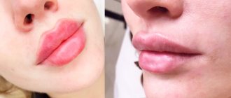 Do you use Botox on your lips?