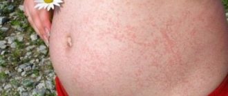 Skin rash during pregnancy