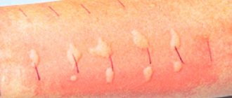 skin tests for allergies for blisters in the groin in men