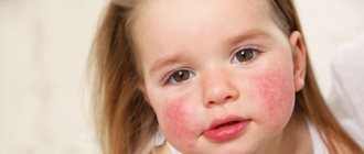 Urticaria in children