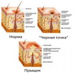 крем от прыщей чистая линия