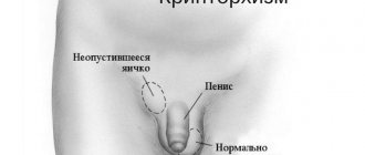 Cryptorchidism