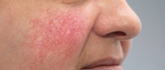 rosacea