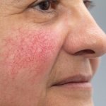 rosacea