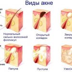 Лактофильтрум от прыщей: отзывы врачей дерматологов с фото до и после. Инструкция по применению, аналоги, цена