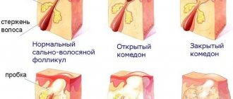 Лактофильтрум от прыщей: отзывы врачей дерматологов с фото до и после. Инструкция по применению, аналоги, цена