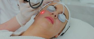 Laser resurfacing of post-acne scars