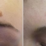 Laser removal of nevus on the face