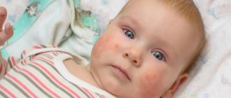 лечение атопического дерматита у младенца