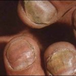 лечение грибка ногтей прополисом