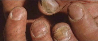 лечение грибка ногтей прополисом