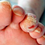 Treatment of chronic wounds. Diabetic foot. Sterile.com 