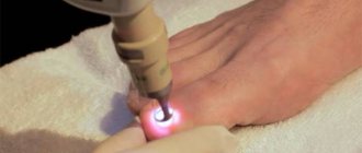 Laser treatment