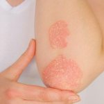 TREATMENT OF PSORIASIS