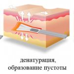 лечение рубцов после акне