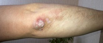 Elbow psoriasis