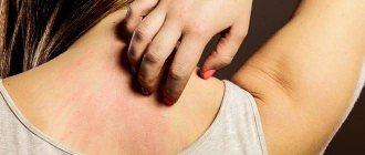 The best remedies for psoriasis