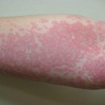 Мазь от аллергии на коже у взрослых