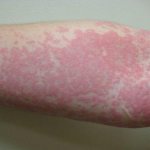 Ointment for skin allergies in adults