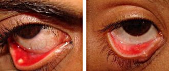 Meibomitis of the upper or lower eyelid