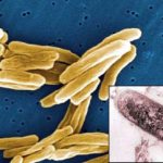 Mycobacterium tuberculosis (MBT).