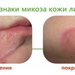 Микоз