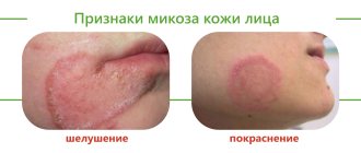 Микоз