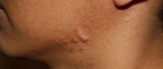 Multiple conglobate acne - photo, spherical, treatment