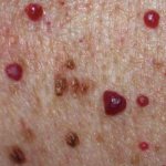 Multiple blood rashes