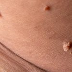 Multiple papillomas on the body: should you think about cancer?