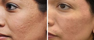 Uneven facial skin texture