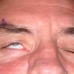 failed blepharoplasty