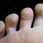 The skin on the soles of the feet peels off: the causes of peeling between the toes, why the skin peels off