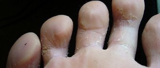 Облазит кожа на ступнях ног: причины шелушения между пальцами, почему слезает кожа
