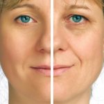 Rejuvenation with cold plasma: minus 10 years in one procedure!