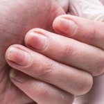 Onychodystrophy of fingernails