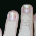 Onycholysis: what to do if the nail peels off?