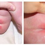 Diaper rash in newborns