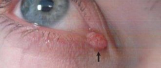 Papilloma on the eyelid removal using folk remedies